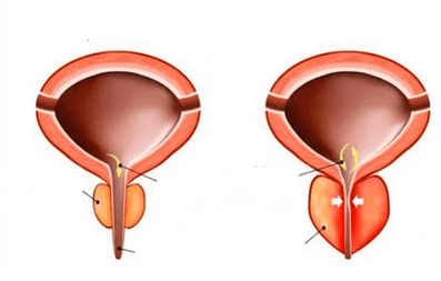Ce este prostatita acută