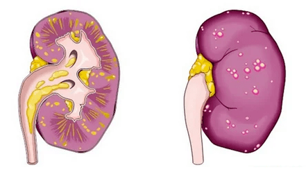 La ce duce prostatita acută