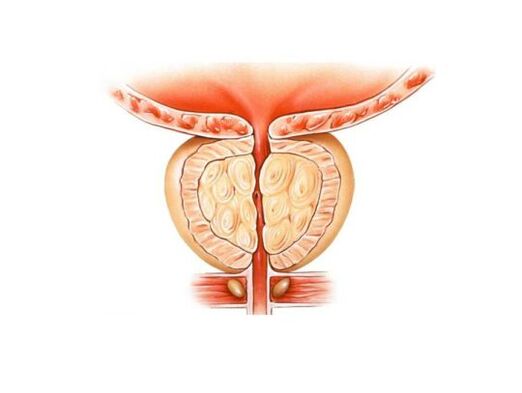 Creșterea prostatei cu prostatită