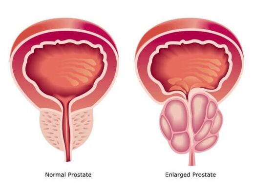Prostată normală și mărită